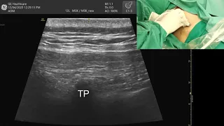 The Erector Spinae Plane (ESP) Block Demo