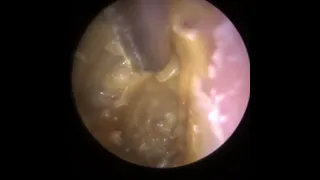 884 - Severely Swollen Outer Ear Infection Suction