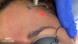 Minimize Acne Scarring With Laser Resurfacing