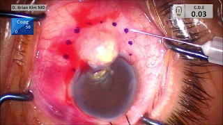 No Touch Technique: Conjunctival Squamous Cell Carcinoma Resection