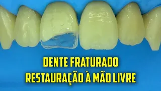 Restauração de dente fraturado em sessão única - Técnica a mão livre