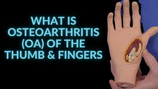 What is Osteoarthritis (OA) of the Thumb & Fingers?