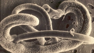 Parasites clue to why allergies are more common in developed countries