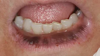 Bizarre Lip Pigmentation Case: Dr. Nemeth's Successful Treatment Revealed!