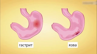 Заболевания желудочно-кишечного тракта