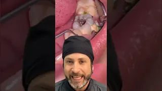 ¡Mira lo que puede ESCONDER los AGUJEROS en los dientes!