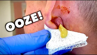 DRAINING AN EAR ABSCESS! (All the Ooze) + Slow Mo Replay  | Dr. Paul