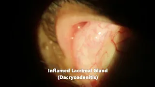 Dacryoadenitis Swollen Lacrimal Gland Coming Out of Eye