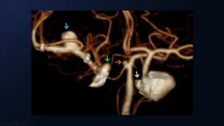 Microsurgical Clipping of Multiple Aneurysms: SCA, Dorsal Carotid Wall, and Stented MCA Aneurysms