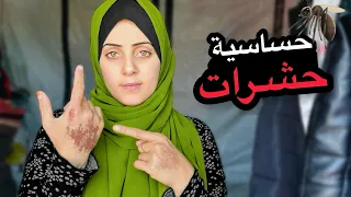 الحشرات داخل خمية النزوح في قطاع غزة عملت عندي حساسية 🥺