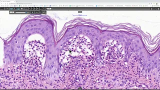 Dermatitis herpetiformis Phillip H McKee, Antonina Kalmykova, CSD Health Care