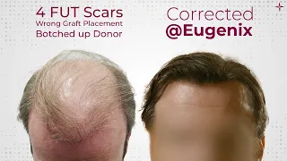 The Ultimate Hair Transplant Challenge: A Challenging Hair Restoration Result achieved