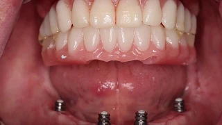 Introduction to the Smart Way to Convert a Denture to Fixed Implant Prosthesis