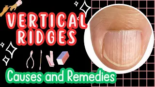 Understanding Vertical Lines on Nails, Main Causes and their Remedies