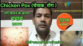 chicken pox in Hindi |चेचक रोग | छोटी माता ओर बड़ी माता रोग ओर बचाव | symptoms and Treatment | RDMS