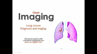 Imaging of lung cancer for diagnosis and staging (DRE) Prof. Mamdouh Mahfouz