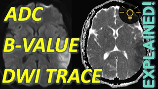 Diffusion Weighted Imaging EXPLAINED (DWI Trace, ADC, B-Values) | MRI Physics Course Lecture 14