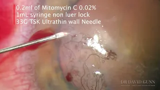 Corneal Neovascularisation treated with Mitomycin Injection