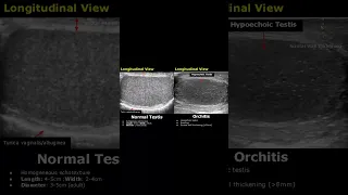 Orchitis Ultrasound Features | Scrotal Scan Normal Vs Abnormal | Testis USG #shorts