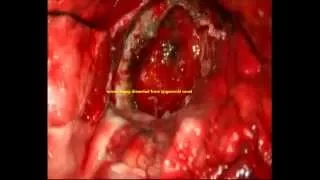 TRIGEMINAL SCHWANNOMA-microsurgical removal-dr suresh dugani /HUBLI /KARNATAK/INDIA