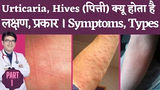 Skin Rash, Urticaria, Hives Causes, Types, Symptoms I Urticaria Hives Kyu Hota hai, lakshan kya hai