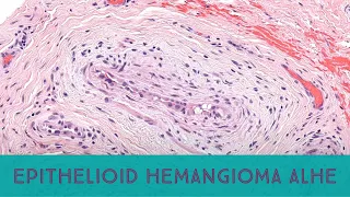 Epithelioid hemangioma/angiolymphoid hyperplasia w eosinophilia (Australasian Dermpath 2022 Case 8)