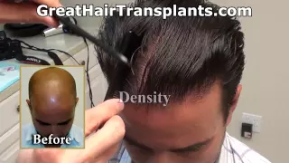 Dr. Brett Bolton Hair Transplant Results