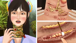 Treatment of pustules on the neck of a long-necked girl｜Intensive phobia be careful｜Parasite removal