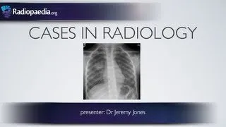 Cases in Radiology: Episode 3 (pediatric, chest x-ray)