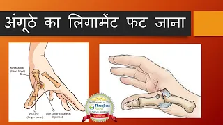 All about ligament injury of thumb in Hindi.