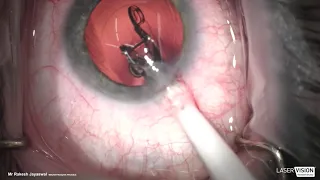 The UK's First Trifocal DUET Procedure