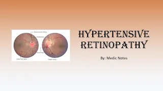Hypertensive retinopathy - signs, pathophysiology