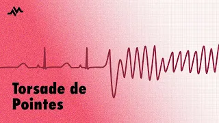 Torsade de Pointes  -  EKG (ECG) Interpretation