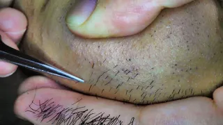 Extractions Ingrown Hair l Tweezers Beard l 2020/9/20