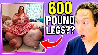Plastic Surgeon Reacts to MY 600 Lb LIFE! How to Lose 600 Lb Legs!