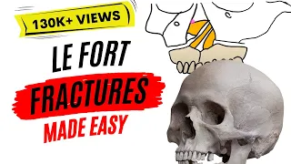 Le Fort fractures | PART ONE |