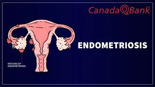 Endometriosis