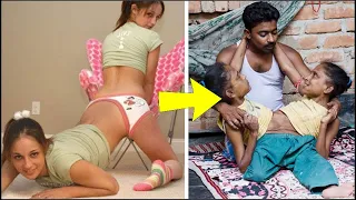 15 Gemelos Siames Que NO Creeras Que Existen