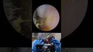 IMPACTED DARK EAR WAX PLUG REMOVAL  - EP721 TEASER