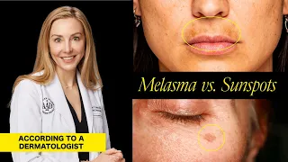 Understanding Melasma and Sunspots: Key Differences, Causes, and Treatment Options