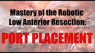 Robotic Low Anterior Resection Port Placement - da Vinci Xi and Si