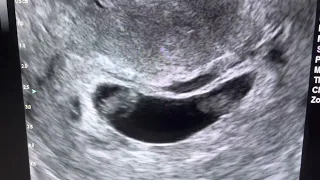 Follow Up of Split Embryo at 7 & 1/7 weeks gestation!