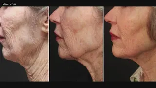 Facelift without surgery? Yes, it's possible, doctors say