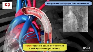 Коарктация аорты: операция стентирования стент-графтом или эндопротезирования грудной аорты