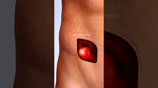 3D Animation of Hernia Repair (Open Procedure for Abdominal Hernia) | #shorts