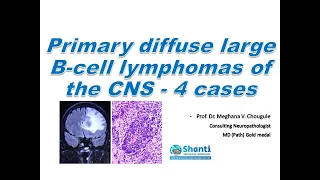 Primary Diffuse Large B-cell Lymphoma of the CNS - 4 cases.