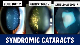 Syndromic cataracts: comprehensive Guide