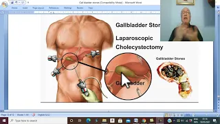 Biliary  disorders in Arabic 4 ( Clinical picture & Treatment  of G.B Stones ) , by Dr. Wahdan