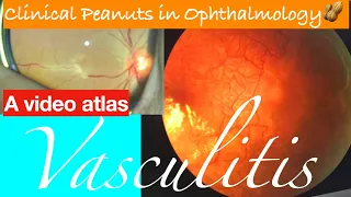 Clinical Peanuts : Retinal Vasculitis 🥜