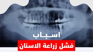 اسباب فشل زراعة الاسنان | الدكتور حمدي العوضي